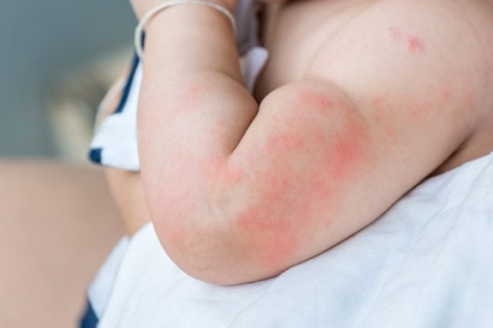 cara mencegah alergi pada anak