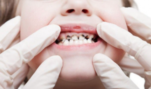 Cara Mencegah Gigi Anak Berlubang